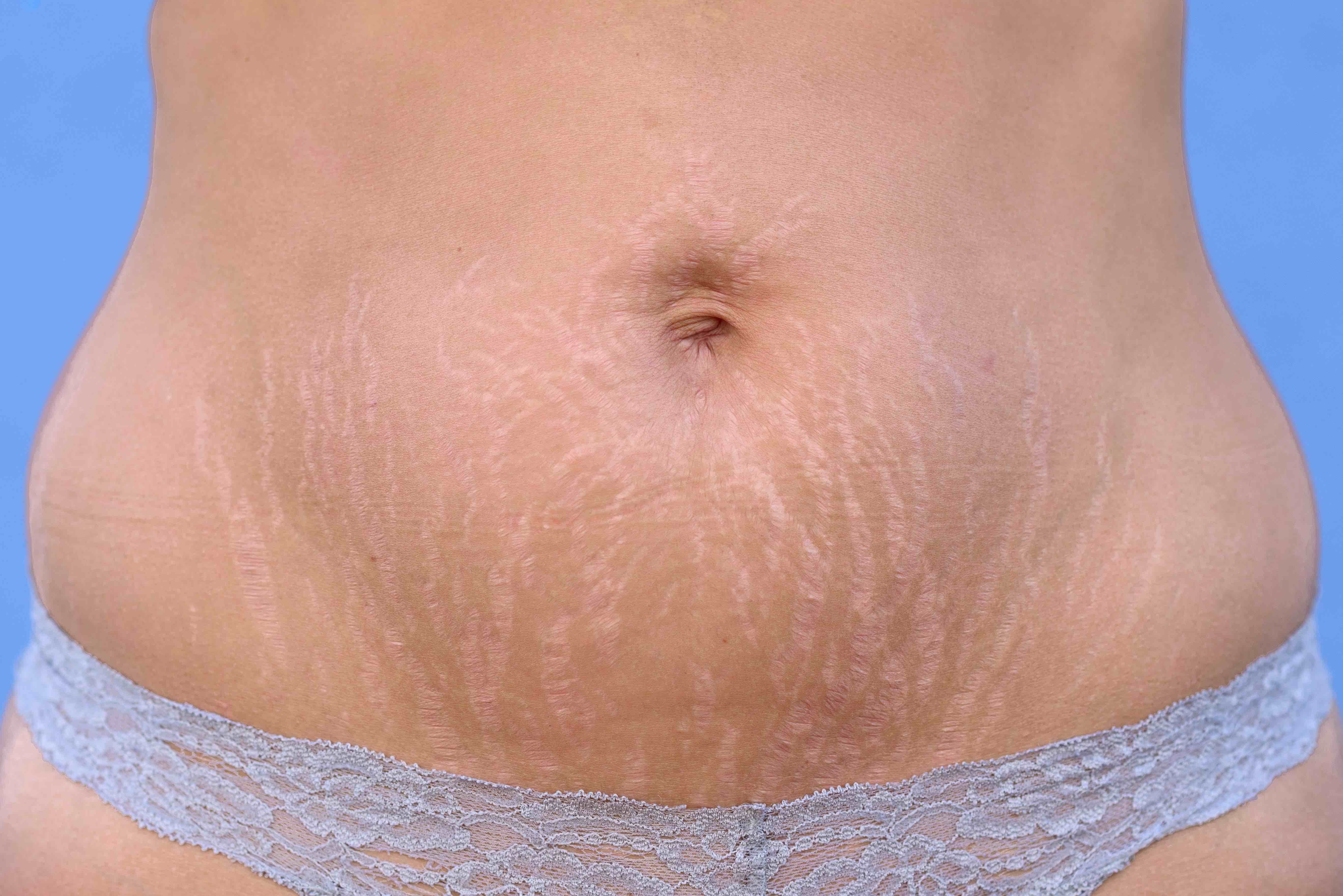 woman with stretch marks